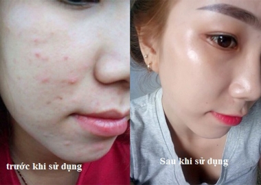 Những thói quen khiến việc trị mụn trứng cá không hiệu quả